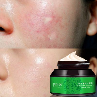 祛痘膏 草本修护30g淡化痘印青春痘净颜祛痘膏