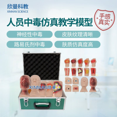 欣曼科教 人员中毒仿真模型 神经性中毒 芥子气中毒 路易氏剂中毒 教学用模型XM-SQ16A