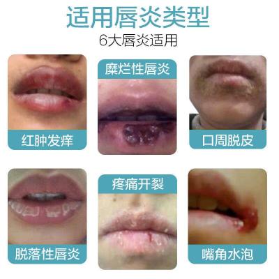 嘴唇唇炎唇膏有效修复嘴唇嘴唇唇炎唇膏有效修复嘴唇干裂嘴角起泡脱皮慢性唇炎药效专用药